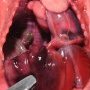 Left diaphragmatic hernia (fetus, 25 weeks)