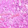 Autoimmune hepatitis