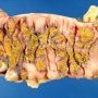Pseudomembranous colitis in infectious colitis with parietal (...)