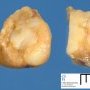 Hepatic localization of a classic Hodgkin lymphoma