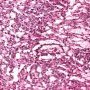 Yolk sac tumor