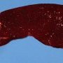 Congestive spleen in spherocytosis