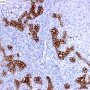 Ductular proliferation in North American Indian cirrhosis (CK19)