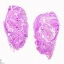 Pilomatrixoma