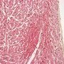 Focal myocardial infarction in thrombotic microangiopathy