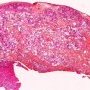 Cardiac rhabdomyoma