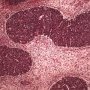 Blastemal component in Wilms tumor