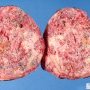Massive Wilms tumor