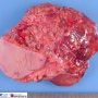 Hypodermal cystic lymphangioma