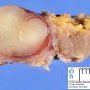 Localized neurofibroma in neurofibromatosis type 1 (NF1)