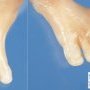 Posta-axial hexadactyly in a Meckel syndrome