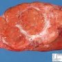 Focal nodular hyperplasia