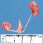 Right simple renal ectopia with renal hypoplasia