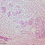Invasive lobular carcinoma of the breast (Credit Ed Uthman)