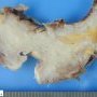 Bladder carcinoma infiltrating the wall