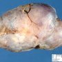 Mammary fibroadenoma