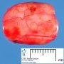 Intradural extramedullary schwannoma