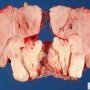 Mature lipoma