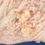 Borderline serous ovarian cystadenoma