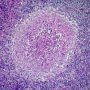 Suppurative epithelioid granuloma in familial granulomatous disease (...)