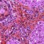 Portal fibrosis and biliary ductular proliferation in juvenile (...)