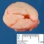 Axilary mammary fibroadenoma