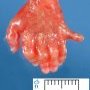 Postaxial polydactyly in trisomy 13