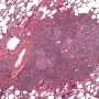 Pulmonary nodular lymphoid hyperplasia