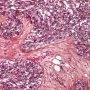 Abdominal desmoplastic small round cell tumor