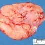 Classical Hodgkin disease type scleronodular