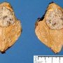 Small hepatoblastoma