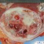 Leiomyomatous renal cell carcinoma