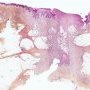 Post-chickenpox acute necrotizing fasciitis