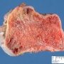 Osteochondroma