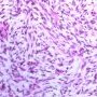 Dermatofibrosarcoma protuberans