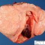 Uterine endocavitary endometrial polyp