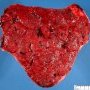 Triangular placenta