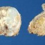 Osteochondroma