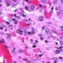 Parvoviral inclusion in fetal liver (hydrops fetalis)