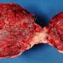 Bilobated placenta