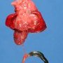 Unilateral renal agenesis with cystic renal dysaplasia. Anorectal agenesis (...)