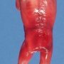 Acrania in anencephaly (21 weeks)