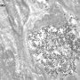 Griscelli disease - Melanocyte ultrastructure