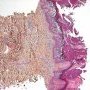 Epidermolytic hyperkeratosis