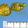 Biliary lithiasis