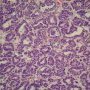Wilms tumor. Epithelial component