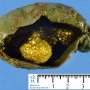 Biliary lithiasis