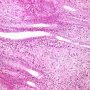 Colonic localization of an infantile myofibromatosis