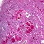 WT1-associated diffuse mesangial sclerosis