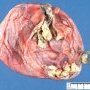 Hair and keratin in an ovarian dermoid cyst